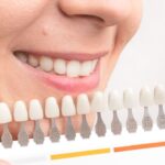 Zęby w trakcie wybielania zębów